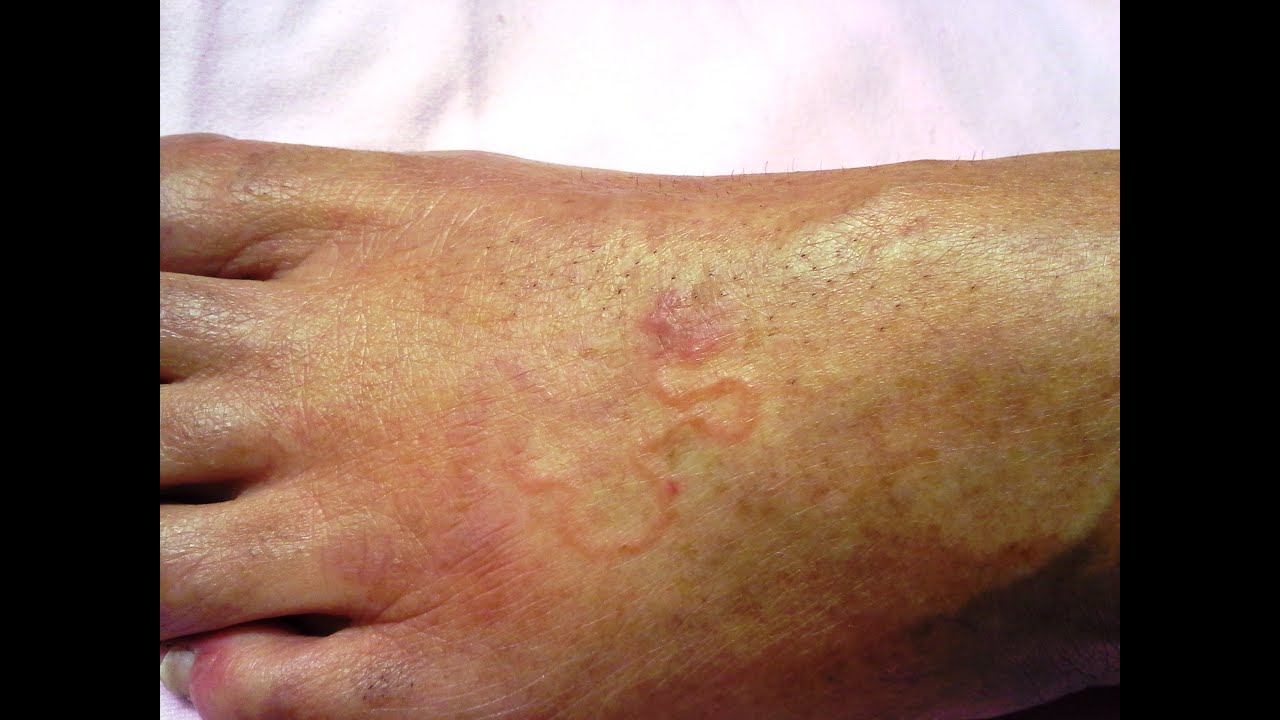 hookworms in humans rash photos